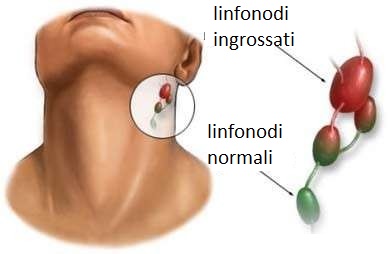 linfonodi1