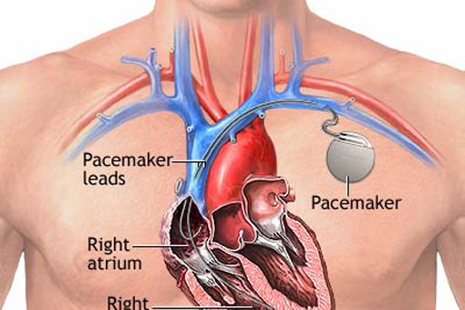 pacemaker 25971