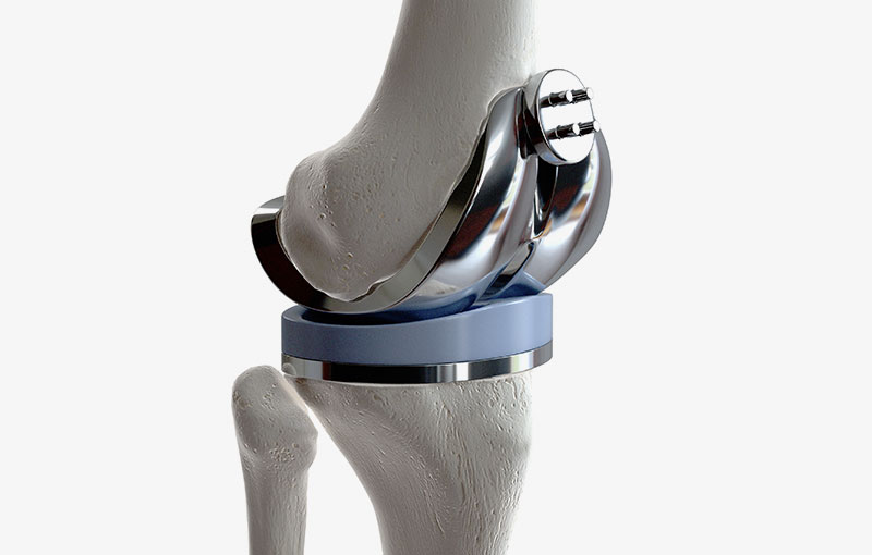 protesi-ginocchio-2.jpg